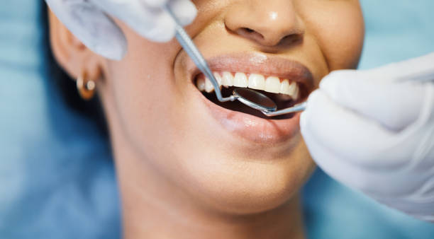 Best Emergency Wisdom Tooth Extraction in Fris, CO
